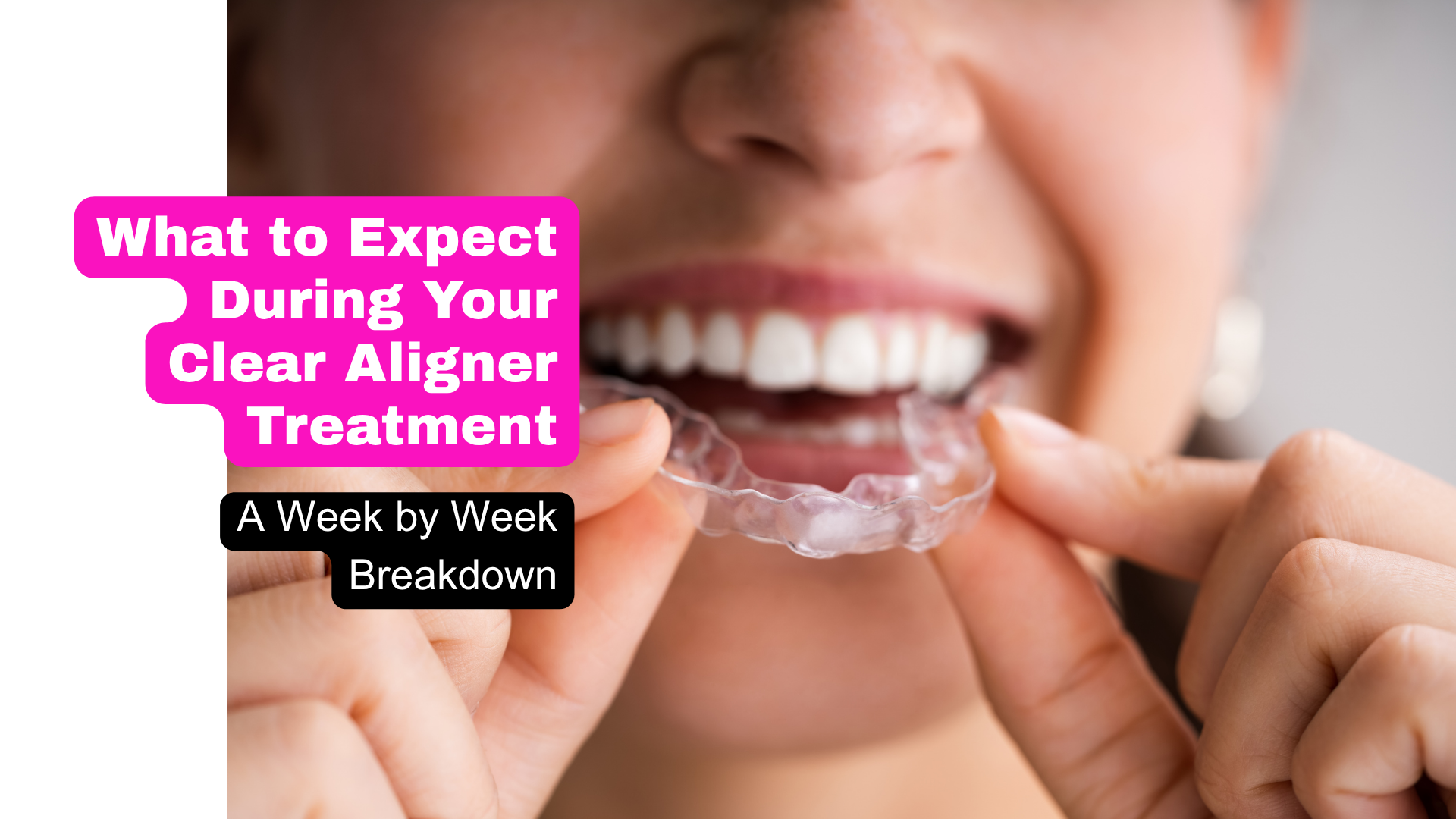 A woman putting on clear braces, or clear aligners, with the text, What to expect during your clear aligner treatment. A week by week breakdown. For the blog post that breaks down what happens during clear aligner treatments.